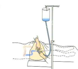 保留灌肠的目的是什么,有哪些注意事项?