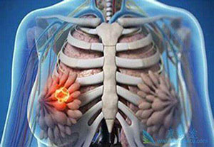 乳腺肿瘤治愈率高吗,治愈率究竟有多高?