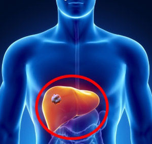 肝癌有哪些症状，如何早发现？