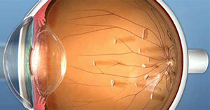 飞蚊症怎么治疗,有哪些有效药物?