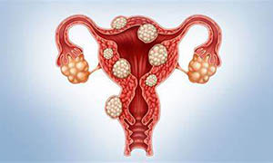 子宫肌瘤是什么,子宫肌瘤会引发哪些症状？